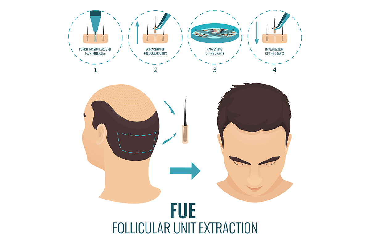 FUE Hair Transplant- Costs, Before and After Results