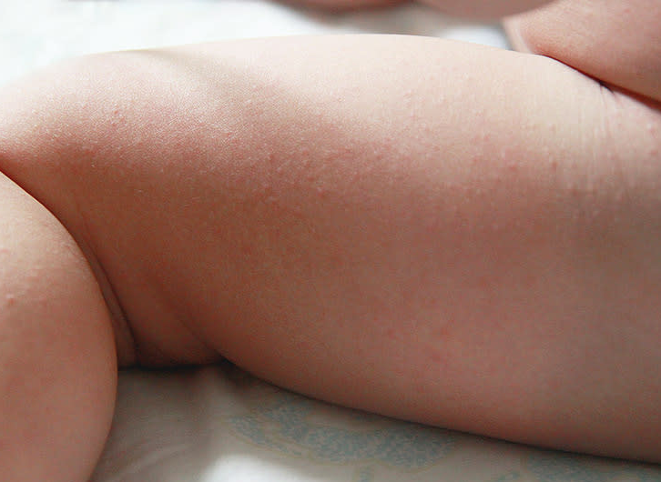 Diapering a Newborn: Distributing with Diaper Rash