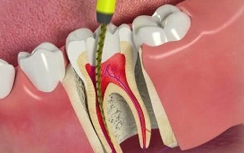 What is Root Canal Treatment? Indications & Cost