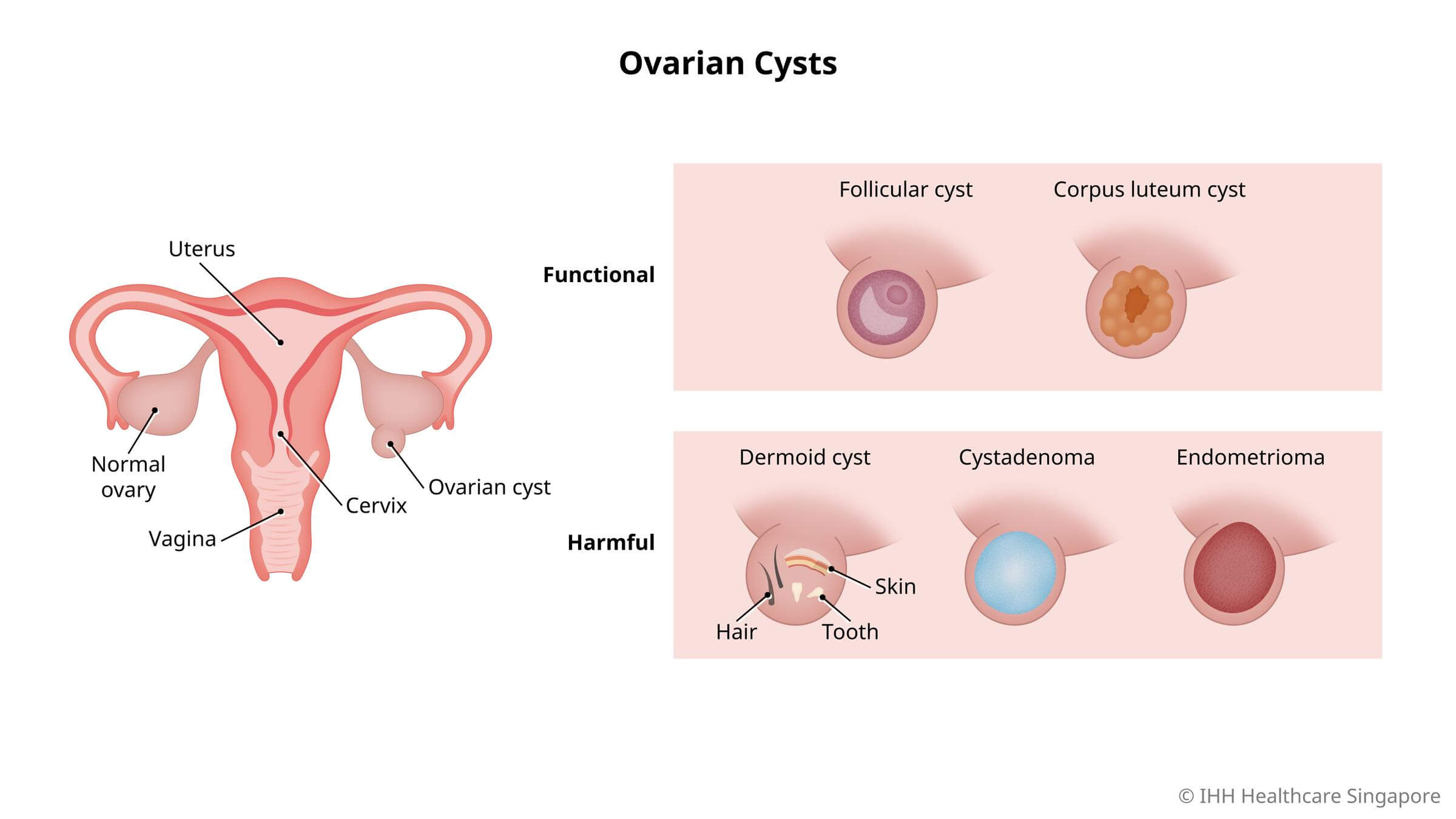 types of ovarian cysts
